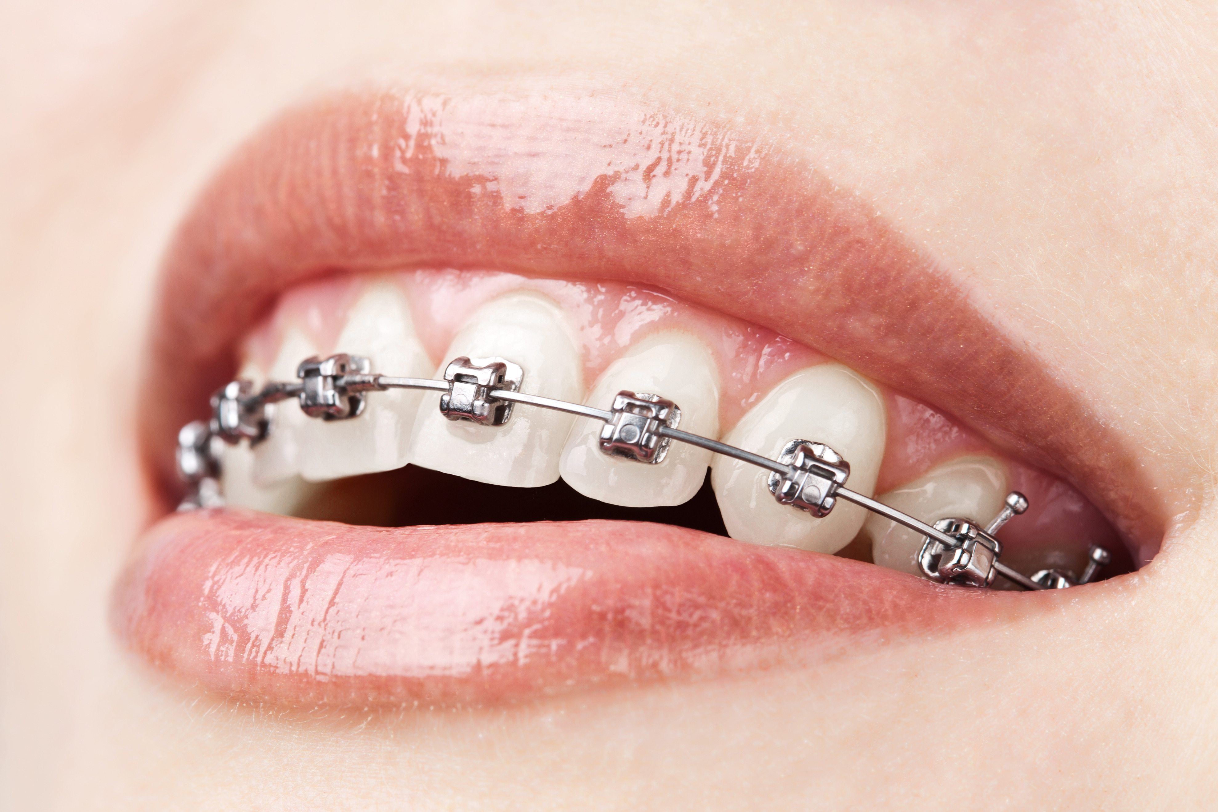 Orthodontics - Fixed Braces