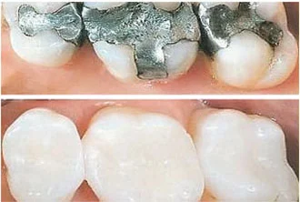 Dental fillings / Restoration