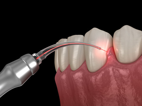 Dental Lasers