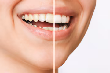 Scaling & Tooth Whitening