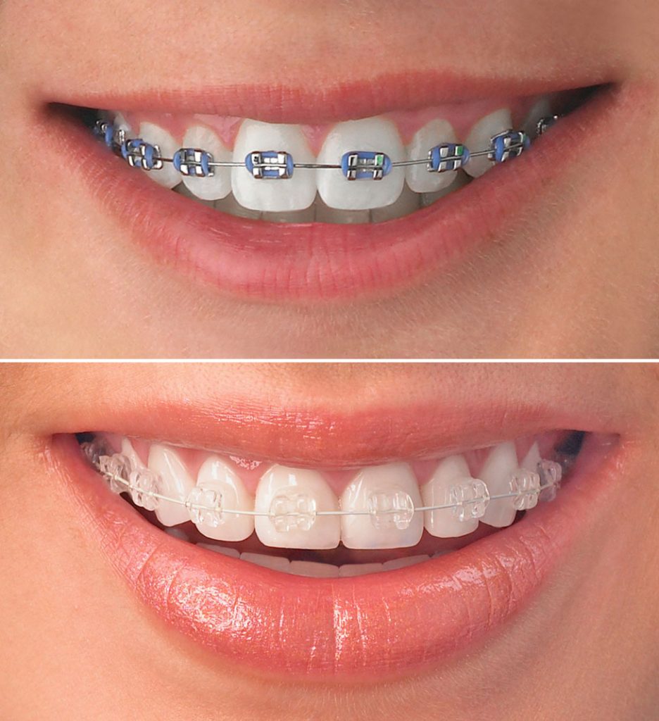 Orthodontics - Fixed Braces