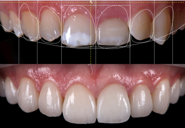 Smile Designing